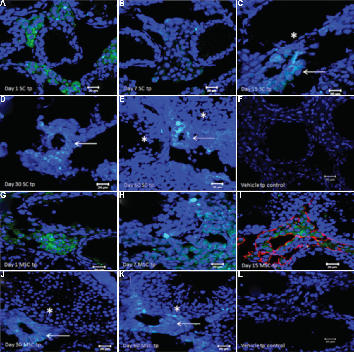 Fate of green fluorescent protein (GFP)-positive Sertoli/mesenchymal cells on transplantation in chemoablated mice testis, studied by immuno-expression of GFP on cryosections. (A and B) GFP+ve Sertoli cells were observed in the interstitium on days 1 and 7 after transplantation, (C) on day 15, GFP+ve cells start to align as neo-tubule-like structures (arrow) in the vicinity of germ cells depleted ‘native’ tubules (*), (D and E) the neo-tubules are retained through days 30 and 60 after transplantation (arrows). Note resumption of spermatogenesis in ‘native’ non-GFP tubules (*) on day 60. (F) No GFP staining in is detected in busulfan-treated controls corresponding to day 30. (G and H) GFP+ve mesenchymal cells were detected in the interstitium on days 1 and 7 after transplantation, (I) GFP+ve cells aligned themselves as neotubule-like structures by day 15 and also colocalized vimentin (red staining) confirming their mesenchymal nature, (J and K) On day 30 and 60 GFP+ve neo-tubules (arrows) were clearly visualized in the vicinity of native tubules showing spermatogenesis (*). (L) No GFP expression was observed in busulfan-treated controls corresponding to day 30. Neo-tubules formed after transplantation of both Sertoli and mesenchymal stromal cells do not differentiate into sperm and only provide paracrine support to the stem cells in the native tubules that survived chemotherapy and undergo spermatogenesis. Source: Reproduced with permission from Ref. 51.